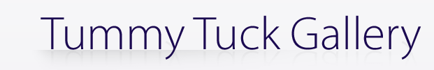 Tummy Tuck Gallery